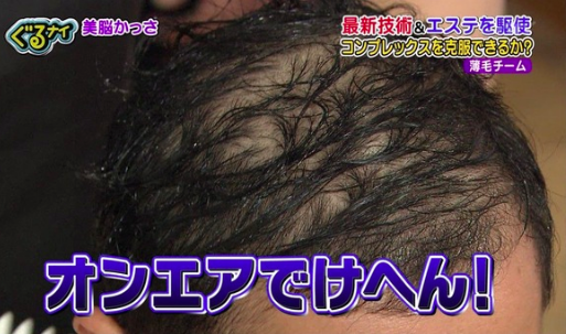 岡村隆史がハゲ治療法で髪の毛増えた 画像で比べてみた 芸能プレス